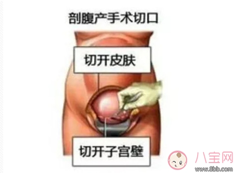 剖腹产孕妇会不会感到疼痛 剖腹产横剖还是纵剖。