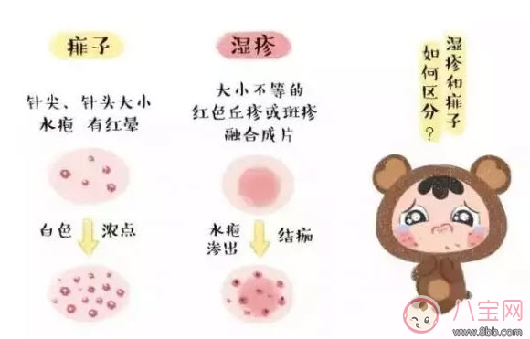 宝宝痱子和湿疹的区别 湿疹和痱子的区别图片
