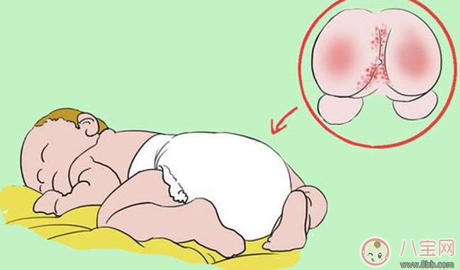 婴儿长尿布疹怎么办 尿布疹是怎么引起的