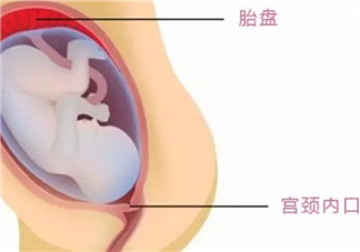 孕妇胎盘低怎么办 孕妇胎盘低是什么原因造成的(胎盘低要注意什么)