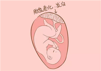 孕晚期胎盘老化能顺产吗 胎盘三级必须剖腹产吗