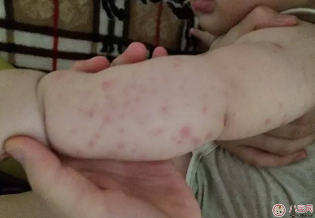 宝宝螨虫过敏怎么办，宝宝被螨虫咬和蚊子咬症状对比图片区别