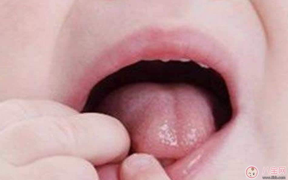 宝宝口腔溃疡原因有哪些 宝宝口腔溃疡怎么办吃什么好的快