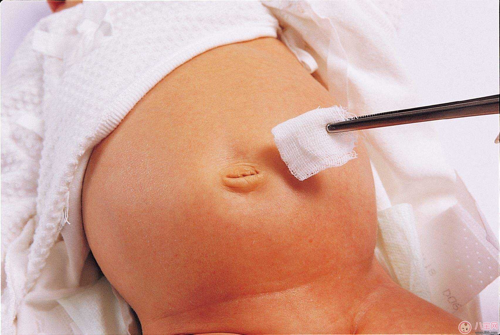 新生儿脐疝症状？如何预防宝宝肚脐感染？