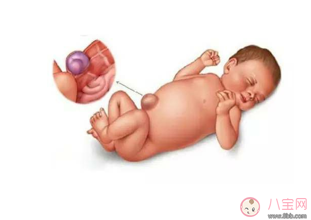 宝宝肚脐出现哪些状况需要立刻就医 怎么保护好宝宝的肚脐