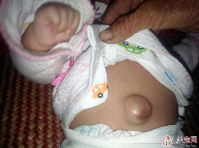 宝宝肚脐出现哪些状况需要立刻就医 怎么保护好宝宝的肚脐