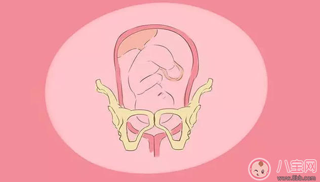 胎儿入盆就是要生了吗 怎么知道胎儿已经入盆了