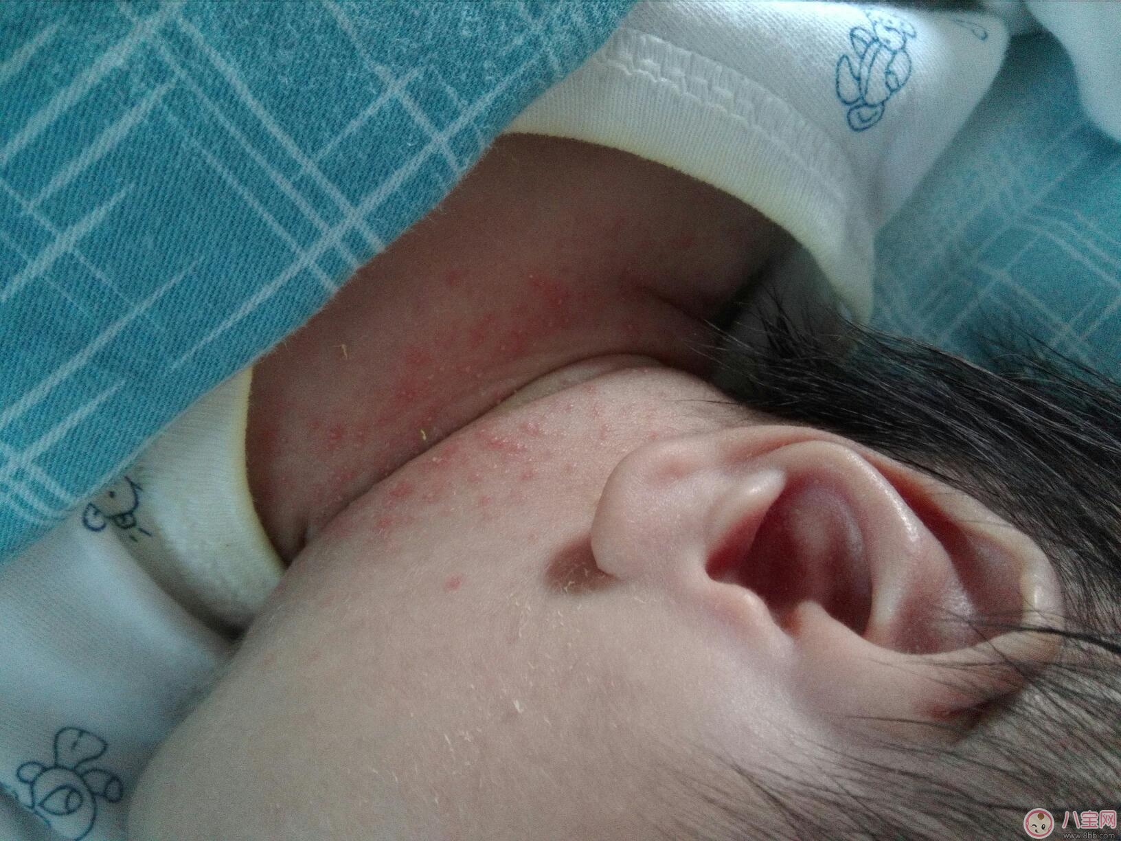 宝宝脖子红疹是衣服刺激引起的吗 宝宝有红疹居家如何护理