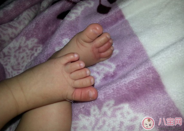 小孩子脚疼怎么办 宝宝说脚疼是哪些原因造成的