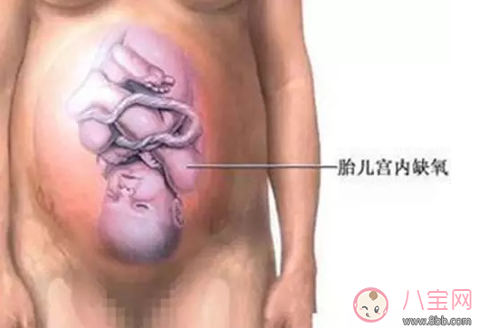 胎宝宝打嗝说明不缺氧是真的吗 胎儿打嗝就能判断证明宫内没缺氧