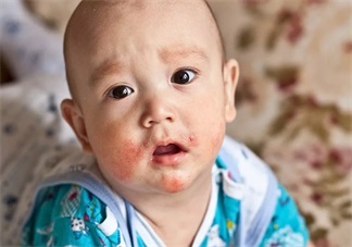 孩子吃哪些食物容易得湿疹 引起宝宝得湿疹的原因