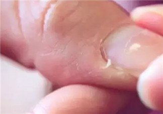 冬天宝宝手指皲裂怎么办怎么护理 冬天小孩手指皲裂怎么预防