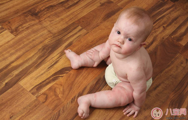 宝宝有荨麻疹怎么办  什么时候该带宝宝去看医生