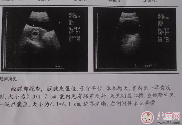 怀三个月男孩孕妇的肚子图片   怀孕三个月生男孩有什么特征
