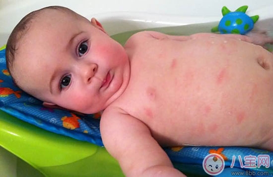 宝宝湿疹跟吃奶粉有关吗 宝宝湿疹后怎么办