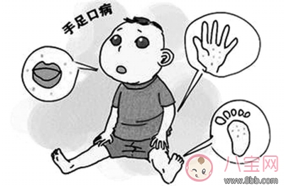 手足口病预防措施有哪些 手足口病传播途径是什么