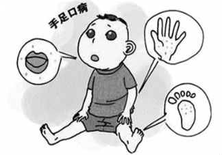 手足口病预防措施有哪些 手足口病传播途径是什么