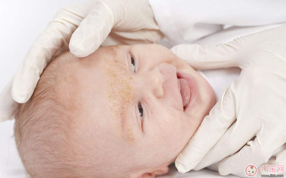 宝宝起湿疹用什么药好  宝宝干性湿疹和过敏性湿疹治疗方法一样吗