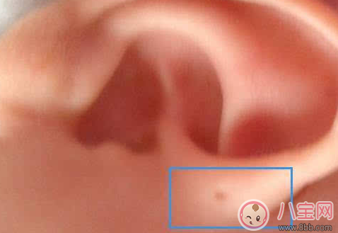 宝宝耳朵上有个小洞是怎么回事 宝宝耳朵上的小洞是遗传吗