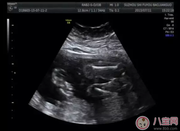 B超胎儿偏大是男孩靠谱吗 看孕早期B超单测男女