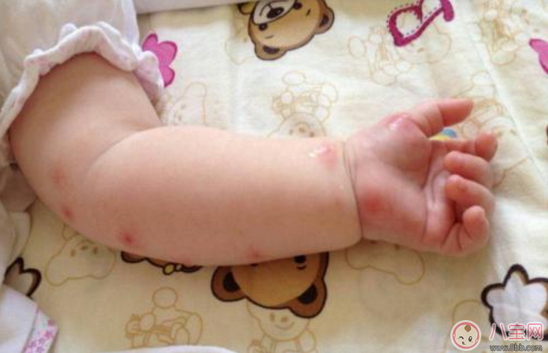 孩子突发荨麻疹怎么止痒 孩子突发荨麻疹的正确做法