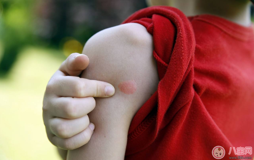 孩子突发荨麻疹怎么止痒 孩子突发荨麻疹的正确做法