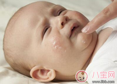 宝宝湿疹可以用激素药吗 宝宝湿疹用激素药的原则