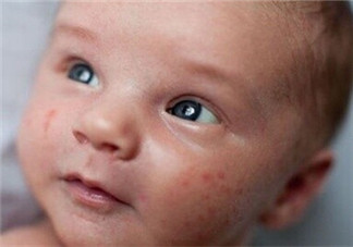 宝宝春季湿疹反复怎么办 怎样有效预防宝宝湿疹