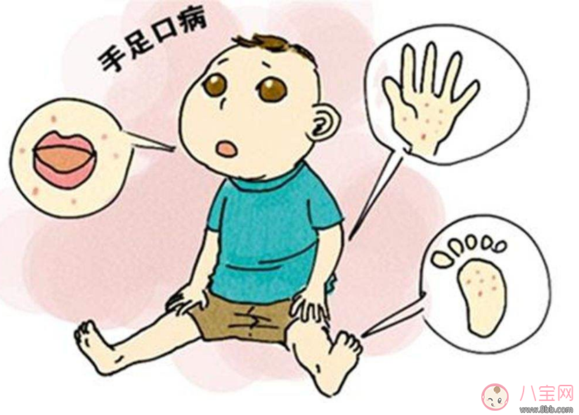 孩子手足口病是什么病 怎么预防手足口病