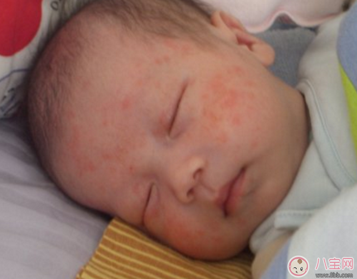 儿童湿疹会传染吗 湿疹常见的症状有哪些