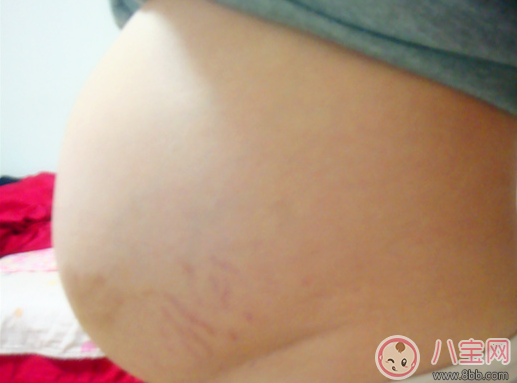 妊娠纹前兆是红点点吗 妊娠纹是长什么样子初期图片