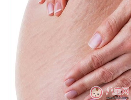 妊娠纹是怎样形成的 孕期长妊娠纹很痒怎么办