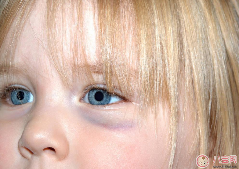 幼儿有黑眼圈怎么回事 小孩有黑眼圈是睡眠不足吗