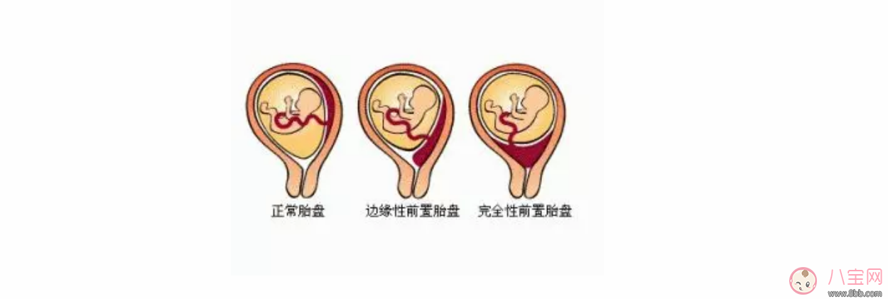 孕妇前置胎盘正常吗 前置胎盘要做哪些检查