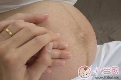 怀孕为什么会长妊娠纹 怀孕长妊娠纹可以预防吗