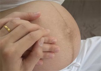 怀孕为什么会长妊娠纹 怀孕长妊娠纹可以预防吗