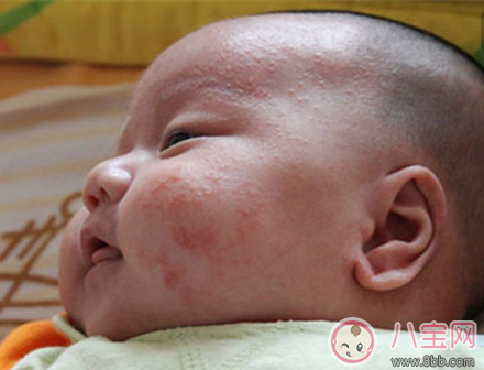 小孩长湿疹有什么症状 春季宝宝长湿疹怎么办