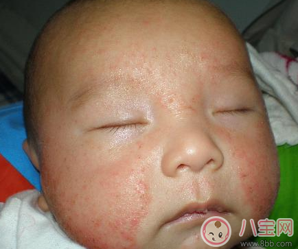 宝宝湿疹反复发作怎么办 湿疹为什么会反复发作