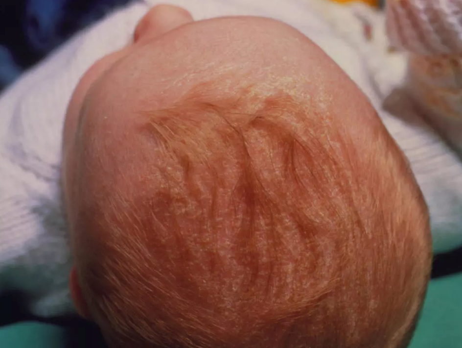 怎么分辨婴儿的皮肤问题 如何快速区分宝宝皮肤病 