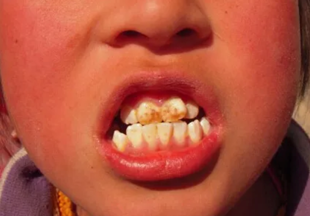 孩子用含氟牙膏会导致氟斑牙吗 3岁以下的孩子有必要用含氟牙膏吗