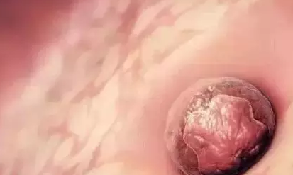 子宫内膜薄能让受精卵着床吗 试管婴儿子宫内膜薄怎么办