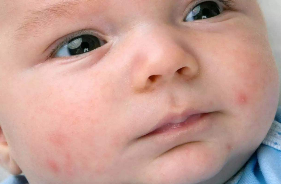 婴儿怎样确定是出疹子 婴儿出疹子如何治疗