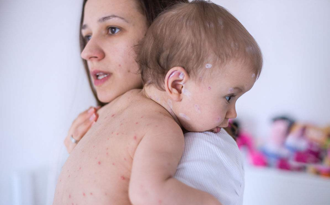 伴随着发烧的发疹疾病有哪些 宝宝发疹应如何处理