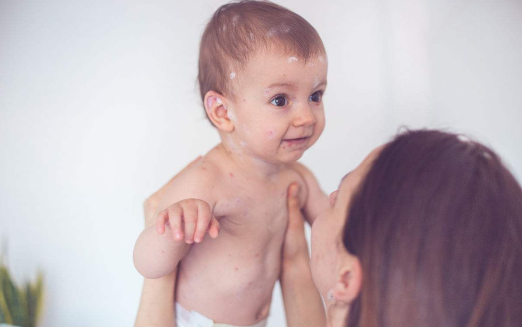伴随着发烧的发疹疾病有哪些 宝宝发疹应如何处理