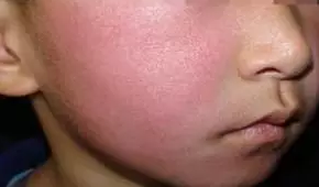皮肤什么时候最容易过敏 脸上过敏是什么症状2018