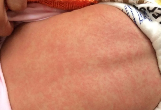 孩子得幼儿急疹会传染吗 孩子幼儿急疹症状分辨