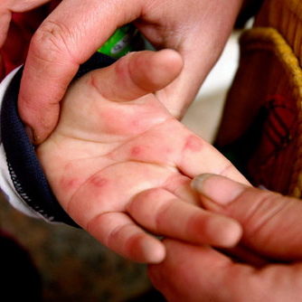 手足口病疫苗接种后是终身免疫吗 手足口病日常预防措施