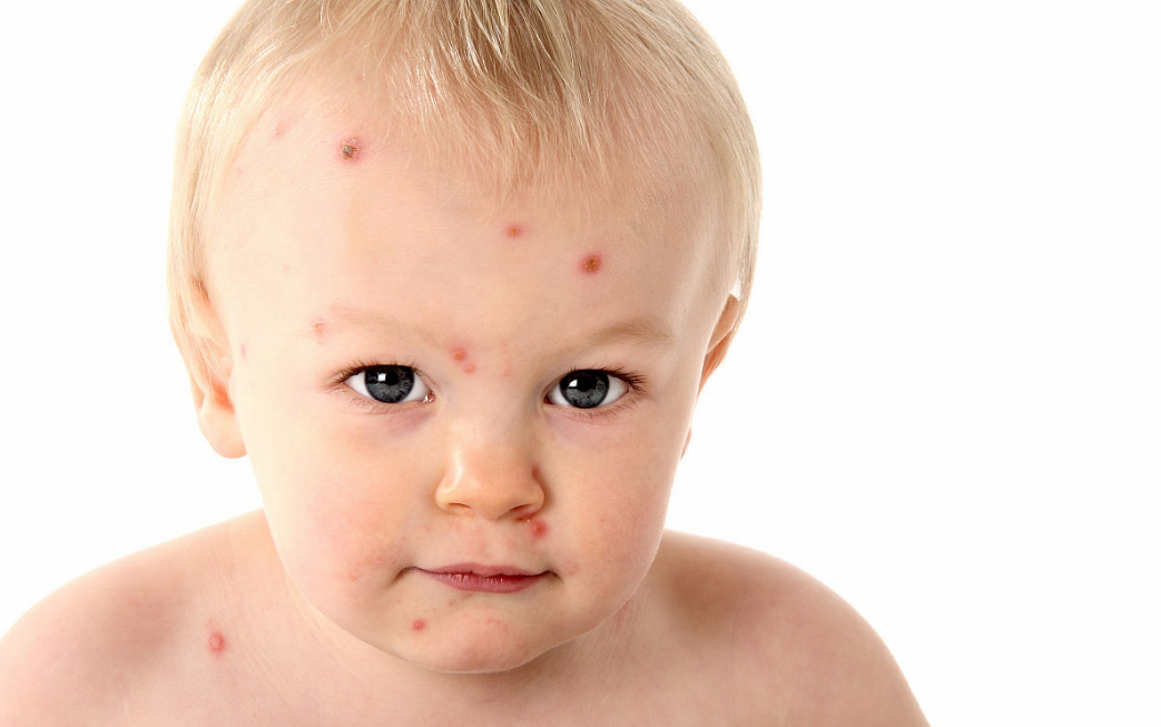 怎么分辨宝宝是不是出疹性疾病 宝宝出疹肌肤如何护理