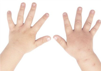为什么手足口病后指甲会脱落 手足口病指甲脱落多久能长出新甲