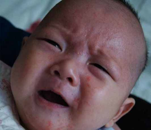 宝宝长痱子和湿疹有什么差别 长痱子和湿疹对比2018